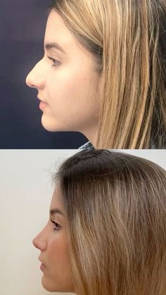 Nose Job Front Profile, Upper Blephoraplasty, Rhinoplasty Inspiration, Nose Job Inspiration Natural, Jaw Reduction Surgery