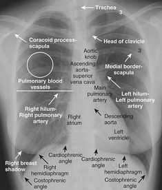 an x - ray shows the chest and ribs with arrows pointing to different areas in it