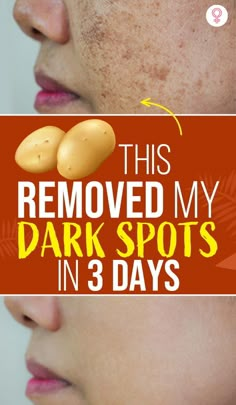 Black Skin Care Dark Spots, Skin Spot Remover, Wrinkles Remedies Face, Brown Spots On Skin, Spots On Skin, Dark Spot Remover, Dark Spots On Face, Diy Masks, Black Skin Care