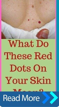 What Do These Red Dots On Your Skin Mean? Appalachian Recipes, Fitness Aesthetics, Haircut For Face Shape, Health Women, Selfie Filters, Women Tips, Diy Cleaning Solution, Feminine Health