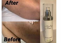 Remove Hyperpigmentation, Removing Hyperpigmentation, Dark Inner Thighs, Use Sunscreen, Increase Height Exercise, Dark Spot Remover, Holistic Diet, Spot Remover, Skin Natural Remedies