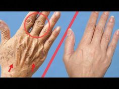 How to Make Your Hands Look 5 Years Younger | Remove Age Spots From Your HandsVata Diethttp://doctorvivekjoshi.com/vata-diet/more videos to watchLiver detoxh... Aging Hands Remedies, Remove Age Spots On Hands, How To Get Rid Of Age Spots On Hands, Dark Spots On Hands How To Remove, How To Remove Age Spots, How To Get Younger Looking Hands, How To Remove Age Spots On Face, How To Make Hands Look Younger, How To Remove Wrinkles From Hands