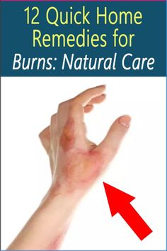 Remedies For Burns, Home Remedies For Burns, Burn Remedy, Burn Relief, How To Heal Burns, Severe Dry Skin, Fresh Aloe Vera Gel, Organic Aloe Vera Gel, Severe Burns