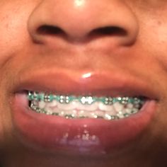 Follow: T I N Y Y 🔥🍭for more Dark Green Braces, Green Braces