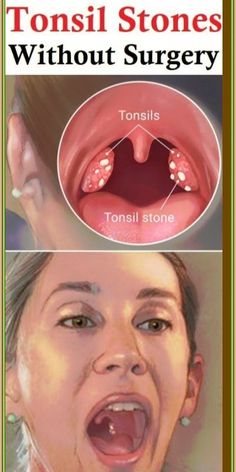 4 Effective Ways To Remove Tonsil  by jennifer Jackson | This newsletter was created with Smore, an online tool for creating beautiful newsletters for educators, businesses and more Men's Health Fitness, Essential Oil Uses, Homemade Skin Care, Skin Concern, Lip Care, Me Time, Fitness Diet, Healthy Drinks