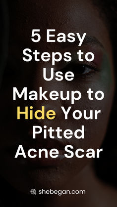 Acne Scar, Easy Steps, Easy Step, Makeup Ideas, Best Makeup Products, Acne