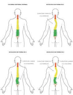 Escoliosis y yoga: lo que se debe y lo que no se debe hacer Forward Head Posture Exercises, Mid Back Pain, Spinal Fusion, Bolesti Chrbta, Best Yoga Poses, Posture Exercises, Yoga Therapy, Qi Gong