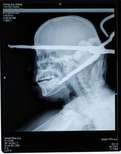 an x - ray image of a man's head and neck with scissors in his mouth