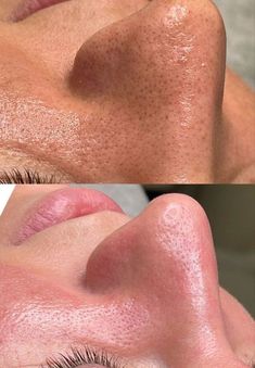 Facial Before And After, Esthetician Inspiration, Facial Routine Skincare, Skin Care Pictures, Facial Routines, Facial Aesthetics, Facial Spa, Skin Clinic