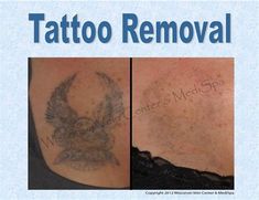 Tattoo Removal Chicago South Suburbs. There are any references about Tattoo Removal Chicago South Suburbs in here. you can look below. I hope this article about Tattoo Removal Chicago South Suburbs can be useful for you. Please remember that this article is for reference purposes only. #tattoo #removal #chicago #south #suburbs Cyprus Greece, Chicago Suburbs, Recipes Healthy, Wisconsin, Philippines, Chicken Recipes, Chicago