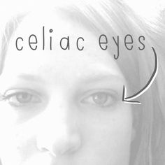 A very raw and real look at what it means to have celiac disease. Read this and then share it with all of your friends and family who don't get it. Celiac Eyes, Celiac Awareness, Gluten Free Info, Coeliac Disease, Going Gluten Free, Gluten Free Living, Diastasis Recti, Gluten Sensitivity, Gluten Intolerance