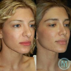 Revision Rhinoplasty