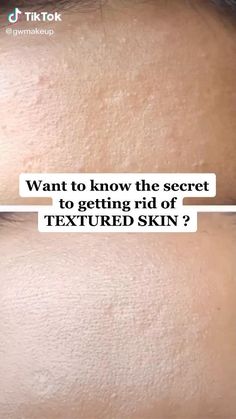 How To Clear Skin Up Fast, Best Products For Textured Skin, Skincare Products For Textured Skin, Textured Skin Routine, Textured Skin Remedies, Clear Up Acne Fast, Bha Liquid Exfoliant, Liquid Exfoliant, For Blackheads