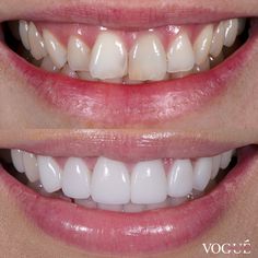 Natural Veneers, Veneer Teeth, Veneer Shapes Teeth, Teeth Makeover, Dental Smile Images, Teeth Cosmetic Dentistry, Cosmetic Dentistry Veneers, Pretty Teeth