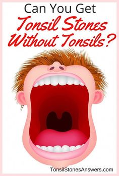 Remove Tonsil Stones by Carolyn Wilkins | This newsletter was created with Smore, an online tool for creating beautiful newsletters for educators, businesses and more I Really Appreciate, I Appreciate You, Natural Home Remedies, I Win, Inspire Me