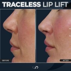 Lip Lift Before And After, Upper Lip Tie, Lip Lift Surgery, Lip Lift, Face Lift Surgery, Injectables Fillers, Botox Injections, Easy Yoga Workouts, Upper Lip