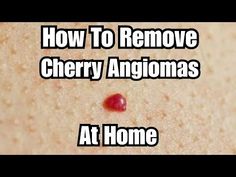 How To Get Rid Of Cherry Angiomas, How To Smell Like Cherry, Tomato Facial At Home, How To Smell Like Cherry Almond, Red Dots On Skin