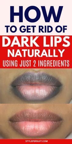 Remedies For Dark Lips, For Dark Lips, Home Remedies For Allergies, Home Remedies For Warts, Lip Lightening, Warts Remedy, Natural Remedies For Migraines, Sunburn Relief, Lip Scrub Homemade