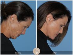 The Difference Between A Deep Plane Facelift & A SMAS Lift | Blog Deep Plane Facelift Before And After, Mini Face Lift Before And After, Facelift Recovery, Mid Face Lift, Lower Face Lift, Deep Plane Facelift, Makeup For Over 60, Neck Lift Surgery, Mini Face Lift