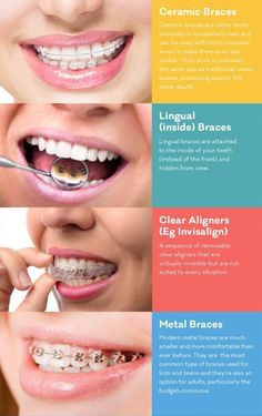 Some of you must be worried and conscious about your irregular teeth. There are different range of braces from metal to invisible ones which help to align your teeth.#Alignmentofteeth not only helps with aesthetics but also in maintaining your oral hygien http://getfreecharcoaltoothpaste.tumblr.com Orthodontic Posters, Type Of Smiles, Different Types Of Teeth, Straighten Teeth Without Braces, Tooth Braces, Different Types Of Braces, Invisible Teeth Braces, Types Of Teeth, Orthodontics Teeth