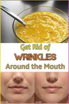 Get rid of skin wrinkles naturally with this herbal remedy >>Watch FREE VIDEO<< Mouth Wrinkles, Get Rid Of Wrinkles, Wrinkle Remedies, Wrinkle Free Skin, Forehead Wrinkles, Natural Anti Aging, Face Wrinkles, Wrinkled Skin