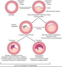 Angina Medsurg Nursing, Med Surg Nursing, Coronary Artery, Emt Paramedic, Nursing School Survival, Nurse Rock