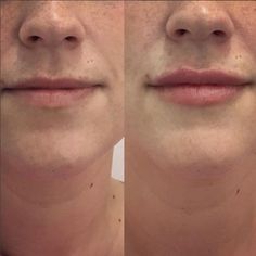 Lip Inspiration, Allergan Botox, Derma Fillers, Lips Fillers, Lip Flip, Lip Surgery, Filler Lip, Anti Aging Skin Care Diy, Lips Inspiration