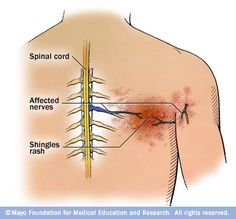 What Causes Shingles, Shingles Remedies, Essential Oils For Shingles, Treating Shingles, Shingles Relief, Nerve Pain Remedies, Armpit Rash, Cold Laser Therapy, Nerve Health