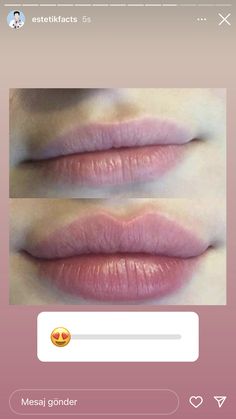 Derma Fillers, Fuller Lips Naturally, Thick Lips, Heart Shaped Lips