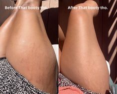 We're just gonna leave this one here... 👀 Link in bio to start reducing stretch marks with That booty tho. ✨ Strech Marks Aesthetics, Laser Stretch Mark Removal, Stretches Marks, Wl Motivation, How To Prevent Pregnancy Stretchmarks, Stretch Mark Cream Pregnancy, Skin Anatomy, Stretch Mark, Beautiful Dresses For Women