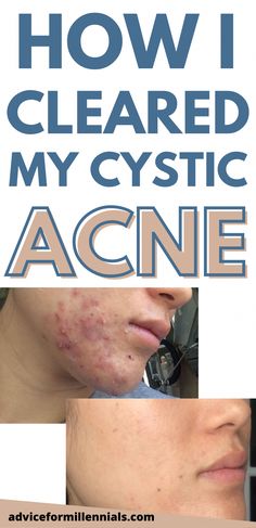 Cystic Acne Remedies, Acne Prone Skin Care, Acne Overnight, Acne Skincare Routine, Severe Acne, Hormonal Acne