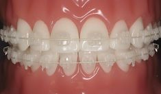 Silver Braces, Kima Sofia, Getting Braces