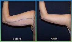 Arm Surgery Plastic Before After, Arm Lipo Before And After, Arm Surgery, Ads Inspiration, Hypertrophic Scars, Laser Eye Surgery, Plastic Fantastic