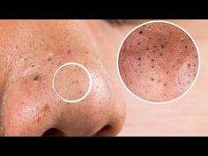 How To Remove Blackheads On The Nose : https://youtu.be/x3em1CVpvXc More Relevant Videos: How to Remove Blackheads From Nose & Face || Naturally at Home || :... White Heads On Nose, How To Remove Blackheads, Remove Blackheads From Nose, Steaming Your Face, To Remove Blackheads, Rid Of Blackheads, Blackhead Mask