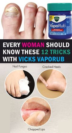 Vic Vaporub, Natural Antifungal, Vicks Vapor Rub, Vicks Vapor, Vicks Vaporub Uses, Uses For Vicks, Nail Fungus Remedy, Vapor Rub, Health Signs