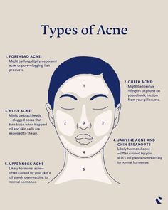 Figuring out what causes acne can be tough, but helping to prevent breakouts just takes a little detective work. Acne face mapping can be key to helping identify the acne cause. While many factors can lead to acne breakouts, the location on your face can be a revealing clue. Click now to find out the meaning behind pimples on your chin, cheeks, jawline and neck. Meaning Of Pimples On Face, Acne Above Lip Meaning, Face Breakout Chart, Pimples And Their Meaning, Acne Chin And Jaw, Pimple Meaning Face Mapping, Pimple On Face Meaning Signs, Acne Causes On Face Chart, Acne Location Meaning Face Mapping