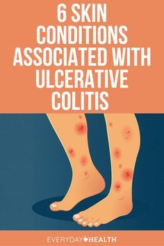 Ulcer Colitus Recipes, Leg Ulcers, Gastrointestinal Tract, Canker Sore, Stomach Ulcers, Medical Knowledge, Oral Health Care, Low Fodmap, Skin Issues