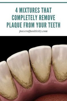 Dental Health Care, Teeth Health, Home Health Remedies, Teeth Care, Oral Health Care, Natural Health Remedies, White Teeth, Healthy Teeth, Health And Beauty Tips