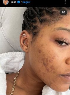 Acne Women, Natural Acne, Types Of Acne, Acne Causes, Simple Skincare Routine, Keke Palmer