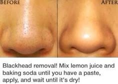 How To: Get Rid Of Blackheads! Jus Lemon, Blackhead Remedies, Black Heads, Skin Pores, Acne Remedies, Beauty Tricks