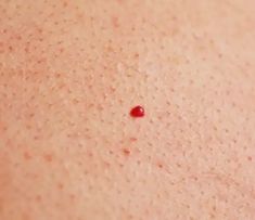 Liver Skin Spots, How To Get Rid Of Cherry Angiomas, Red Dots On Skin, Cherry Angioma Removal, Red Skin Spots, Cherry Angioma, Blood Blister, Red Moles, Skin Moles