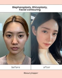 For pricing inquiries, please contact us contact@beautyhopper.com Korean Plastic Surgery Before And After, Kpop Plastic Surgery, Face Treatments