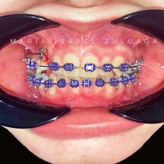 Cute braces colors | Braces colors | Getting braces | Cute braces | Braces teeth colors | Teeth braces Shark Teeth Grillz, Blue And Purple Braces Teeth, Braces Cute, Rainbow Grillz, Rine Stone On Teeth, Grillz Girls Teeth, Shiny Teeth