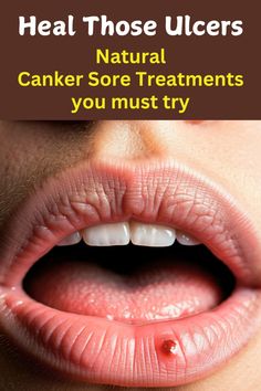 Tired of those pesky canker sores? Say goodbye to painful ulcers with these natural, effective home remedies! Discover simple, affordable ways to soothe, heal, and prevent canker sores. From honey and salt rinses to aloe vera and tea tree oil, these remedies offer relief without harsh chemicals. Learn how to tackle canker sores like a pro and enjoy a pain-free smile.  #cankersorehomeremedies #cankersores #naturalremedies #homecare #healthtips #oralhealth #wellness #painrelief #DIY #health #beauty #lifestyle Canker Sore Remedy Overnight, Canker Sore Home Remedies, Sore Feet Remedies, Acne Free Diet, Ginger Shot Benefits, Zinc Supplements, Ways To Heal