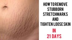 THIS SUPER REMEDY WILL GET RID OF YOUR STRETCHMARKS FAST|| Simple Stretchmarks Fix in  21 Days