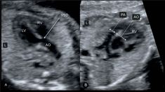 an x - ray shows the different stages of breast surgery