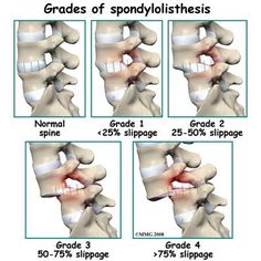 Spondylolisthesis grades Physical Therapist Assistant, Cervical Spondylosis, Spinal Surgery, Spine Surgery, Sciatic Nerve Pain, Medical Anatomy, Sciatic Nerve, Medical Knowledge