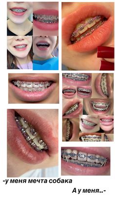 Брекеты Perfect Teeth Braces, Teeth Gems