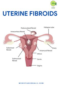 Uterine Fibroid Diet, Fibroid Remedies, Fibroid Surgery, Inflammation Diet, Female Health, Ayurvedic Doctor