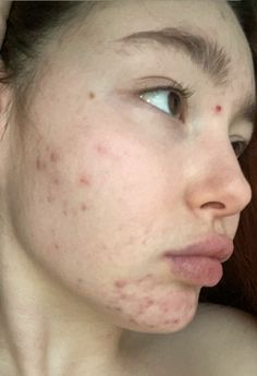 #acne #face #skincare #natural #naturalbody #naturalface #beauty #blessing #itisgood #gifted #beautiful #gorgeous #instagram #1 #viralpost #aesthetic #emmikyc #pintrest Blackhead Extraction, Blackhead Remedies